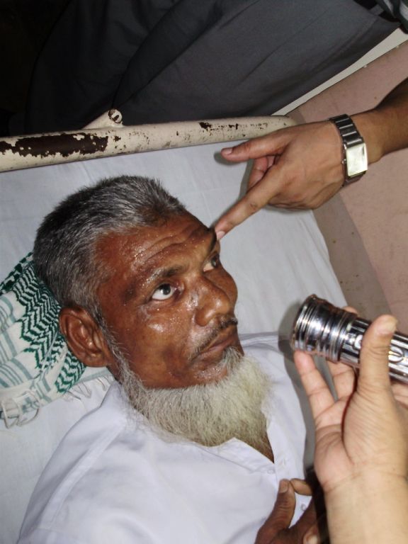 This patient has one glass eye and cataracts in the remaining eye. Here in a Rotary Eye Clinic he undergoes an initial examination prior to surgery